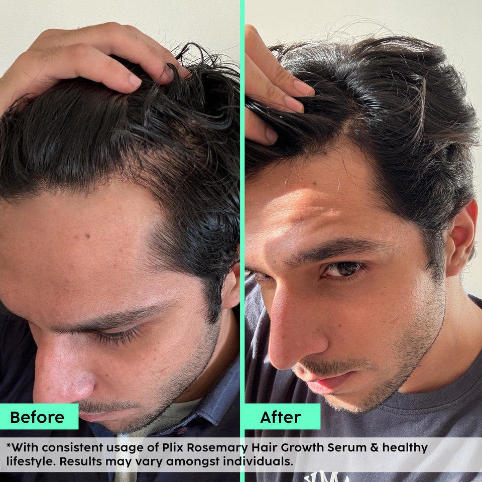 Rosemary Advanced Hair Growth Serum for Male Pattern Baldness | Promotes New Hair Growth