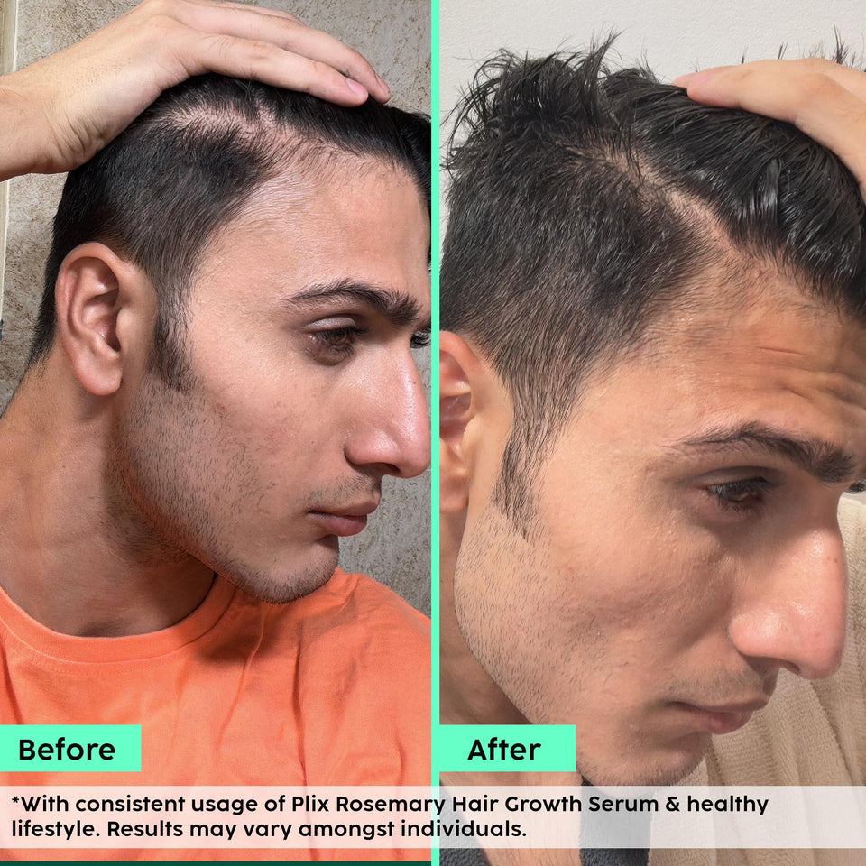 Rosemary Advanced Hair Growth Serum for Male Pattern Baldness | Promotes New Hair Growth